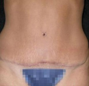 Tummy Tuck Before and After Pictures Glastonbury, CT
