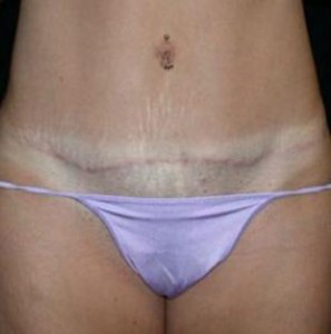 Tummy Tuck Before and After Pictures Glastonbury, CT