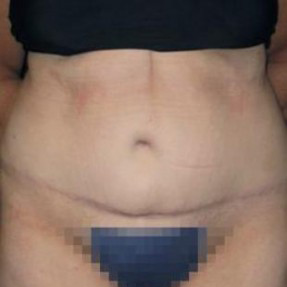 Tummy Tuck Before and After Pictures Glastonbury, CT