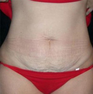 Tummy Tuck Before and After Pictures Glastonbury, CT