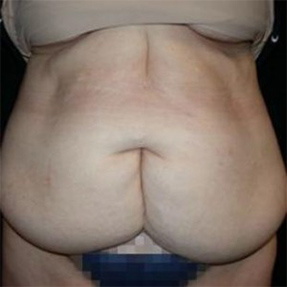 Tummy Tuck Before and After Pictures Glastonbury, CT
