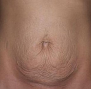 Tummy Tuck Before and After Pictures Glastonbury, CT