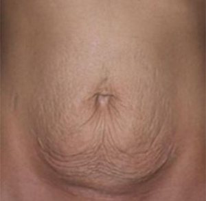 Tummy Tuck Before and After Pictures Glastonbury, CT