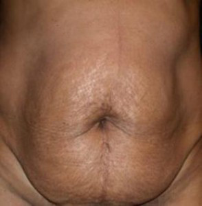 Tummy Tuck Before and After Pictures Glastonbury, CT
