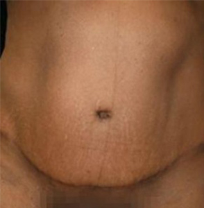 Tummy Tuck Before and After Pictures Glastonbury, CT