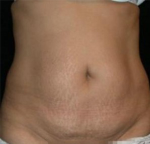 Tummy Tuck Before and After Pictures Glastonbury, CT