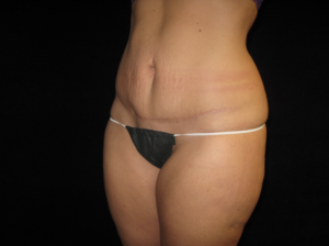 Abdominoplasty Before and After Pictures Glastonbury, CT