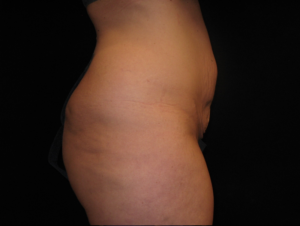 Abdominoplasty Before and After Pictures Glastonbury, CT