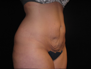 Abdominoplasty Before and After Pictures Glastonbury, CT