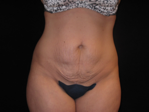Abdominoplasty Before and After Pictures Glastonbury, CT
