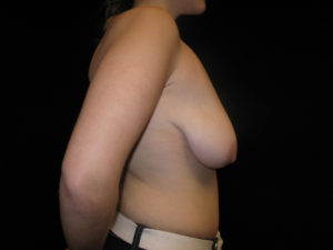 Breast Lift Before and After Pictures Glastonbury, CT