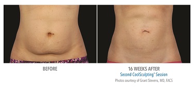 CoolSculpting® Before and After Pictures Glastonbury, CT
