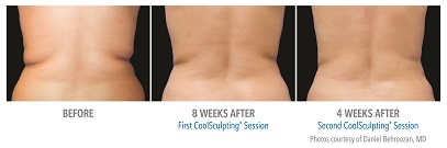 CoolSculpting® Before and After Pictures Glastonbury, CT