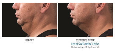 CoolSculpting® Before and After Pictures Glastonbury, CT