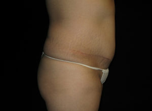 Abdominoplasty Before and After Pictures Glastonbury, CT