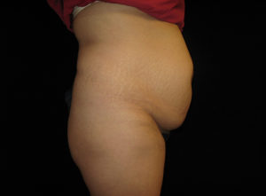 Abdominoplasty Before and After Pictures Glastonbury, CT