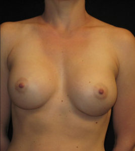 Breast Augmentation Before and After Pictures Glastonbury, CT