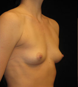 Breast Augmentation Before and After Pictures Glastonbury, CT