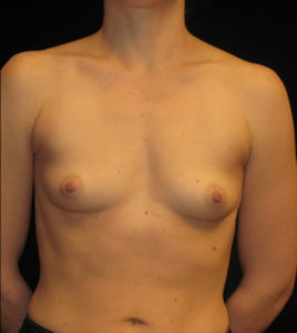 Breast Augmentation Before and After Pictures Glastonbury, CT