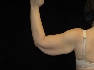 Arm Lift Before and After Pictures Glastonbury, CT