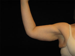 Arm Lift Before and After Pictures Glastonbury, CT