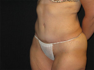Abdominoplasty Before and After Pictures Glastonbury, CT