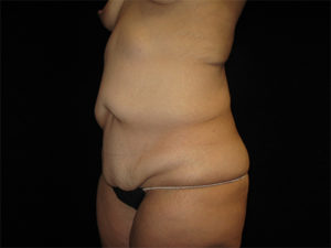 Abdominoplasty Before and After Pictures Glastonbury, CT