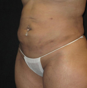 Abdominoplasty Before and After Pictures Glastonbury, CT