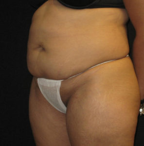 Abdominoplasty Before and After Pictures Glastonbury, CT