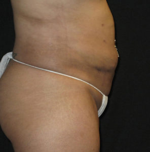 Abdominoplasty Before and After Pictures Glastonbury, CT