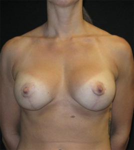Breast Augmentation Before and After Pictures Glastonbury, CT