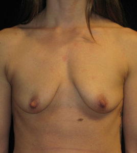 Breast Augmentation Before and After Pictures Glastonbury, CT