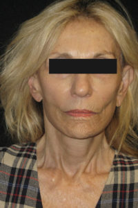 Laser-Ablative Before and After Pictures Glastonbury, CT