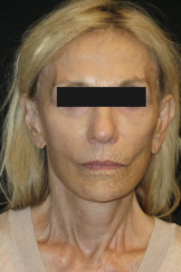 Laser-Ablative Before and After Pictures Glastonbury, CT