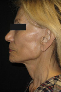 Laser-Ablative Before and After Pictures Glastonbury, CT