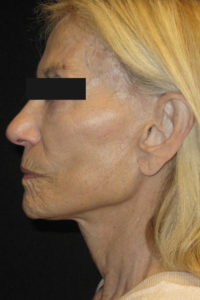 Laser-Ablative Before and After Pictures Glastonbury, CT