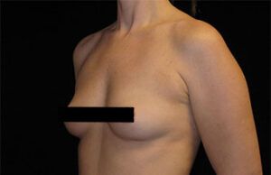 Breast Augmentation Before and After Pictures Glastonbury, CT