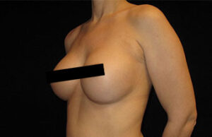 Breast Augmentation Before and After Pictures Glastonbury, CT