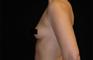 Breast Augmentation Before and After Pictures Glastonbury, CT