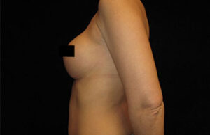 Breast Augmentation Before and After Pictures Glastonbury, CT