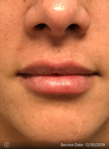 LIP AUGMENTATION BEFORE AND AFTER PICTURES GLASTONBURY, CT