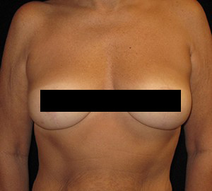 Breast Lift Before and After Pictures Glastonbury, CT