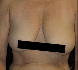 Breast Lift Before and After Pictures Glastonbury, CT