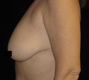 Breast Lift Before and After Pictures Glastonbury, CT
