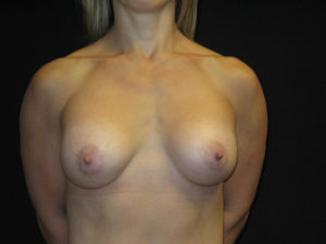 Breast Augmentation Before and After Pictures in Glastonbury, CT