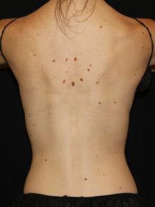 CoolSculpting® Before and After Pictures Glastonbury, CT