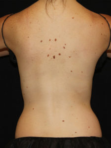 CoolSculpting® Before and After Pictures Glastonbury, CT