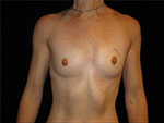 Breast Reconstruction Before and After Pictures Glastonbury, CT