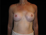 Breast Reconstruction Before and After Pictures Glastonbury, CT