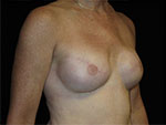 Breast Reconstruction Before and After Pictures Glastonbury, CT